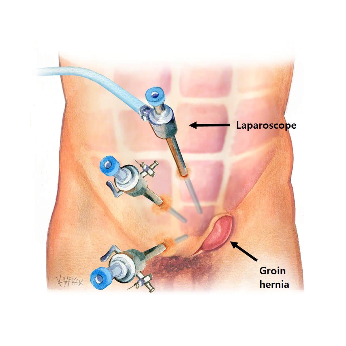Laparoscopica_Hernia_Inglinal