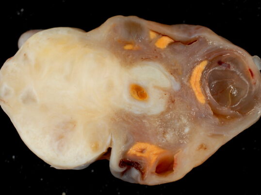 Fibroma of the Ovary
