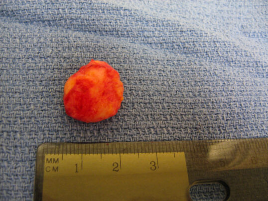 Ma Ma Ma My Lipoma